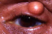 Chalazion โ eyelid cyst